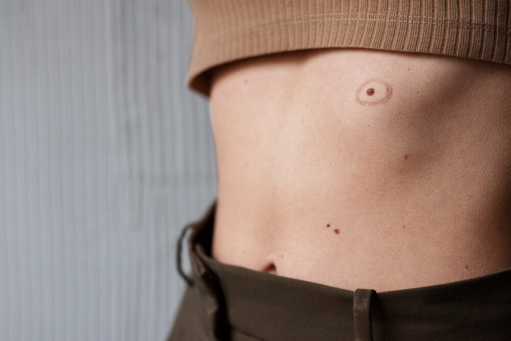 Skin Cancer FDL Dermatology in Arlington VA moles evaluation at FDL Dermatology in Arlington VA