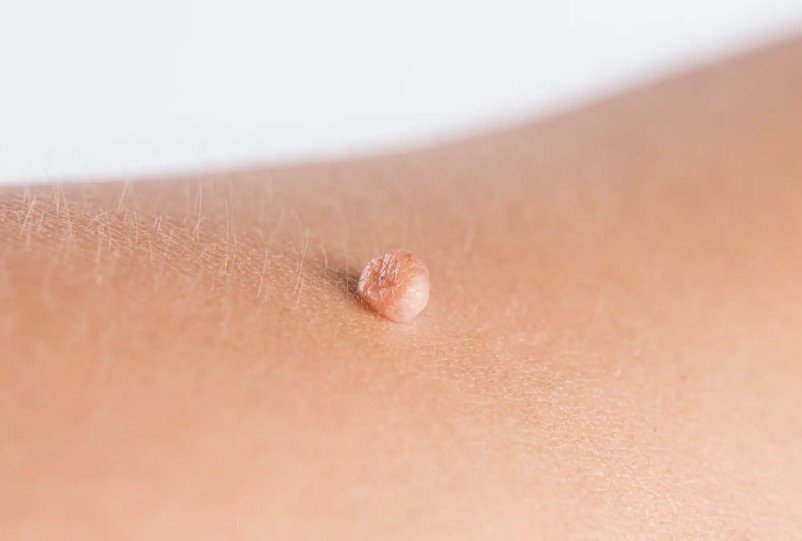Skin Tags FDL Dermatology in Arlington VA