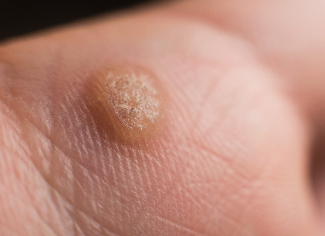 moles evaluation at FDL Dermatology in Arlington VA