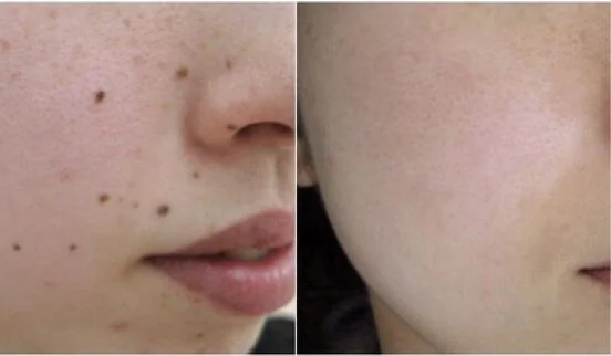 acne-treatment-ba2 FDL Dermatology acne-treatment-ba1 FDL Dermatology