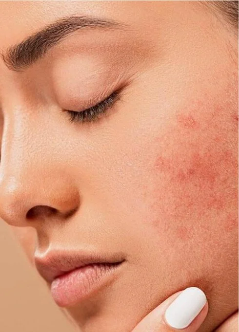 medical-services-acne FDL Dermatology in Arlington VA cosmetic-treatment-botox FDL Dermatology in Arlington